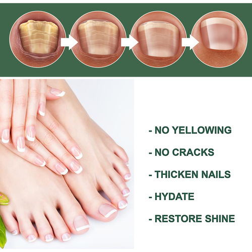 eelhoe Onychomycosis Repair Solution Thickening Bright Nail Soft Nail Solution Foot Care Solution Onychomycosis Manicure Care Solution