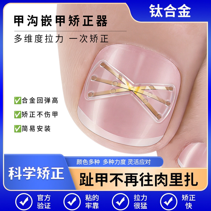 Ingrown Toenail Correction Device Made of Nickel-Titanium Alloy with Steel Wire and Titanium Alloy Bionic Patch for Toenail Inflammation Correction Ingrown Toenail Correction Device Made of Nickel-Titanium Alloy with Steel Wire and Titanium Alloy Bionic Patch for Toenail Inflammation Correction