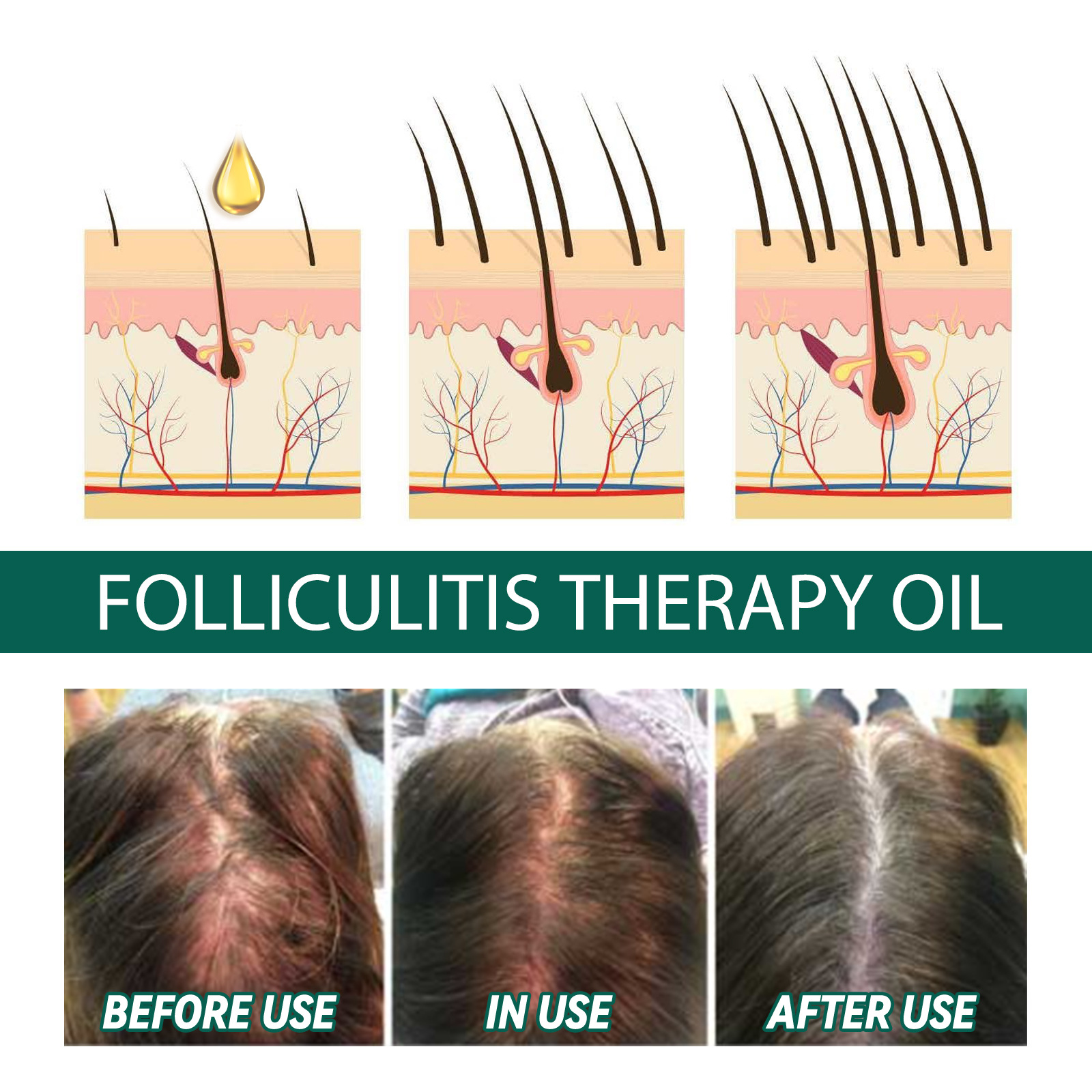 Olio essenziale EELHOE per la cura del cuoio capelluto e dei capelli, pulizia profonda del cuoio capelluto, riparazione delle radici dei capelli, antiprurito, prevenzione della caduta dei capelli e cura solida dei capelli_voghion.com
