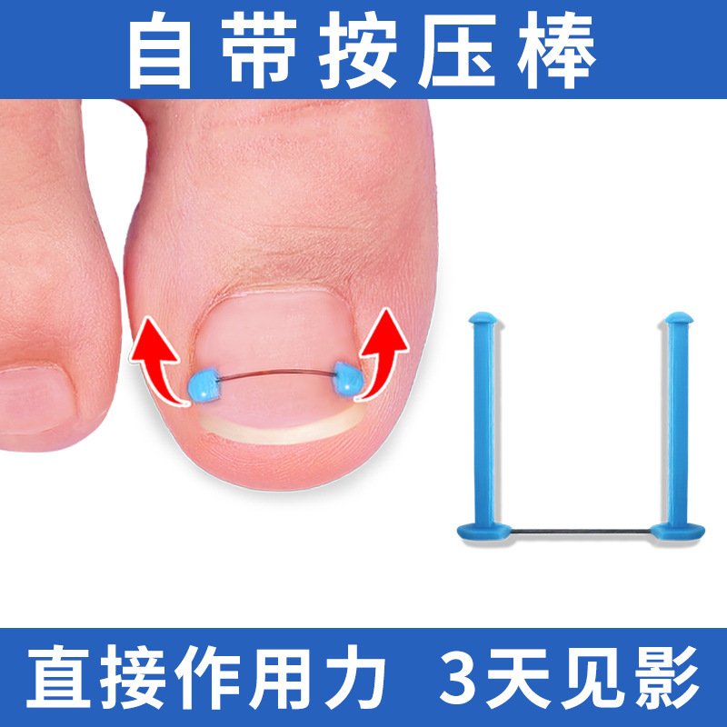Nail tie meat correction silk nail extension rod nickel alloy embedded nail nail nail buckle corrector nail pad Nail tie meat correction silk nail extension rod nickel alloy embedded nail nail nail buckle corrector nail pad