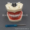 Dental teaching model doctor-patient communication model comprehensive case model removable dental model implant restoration model