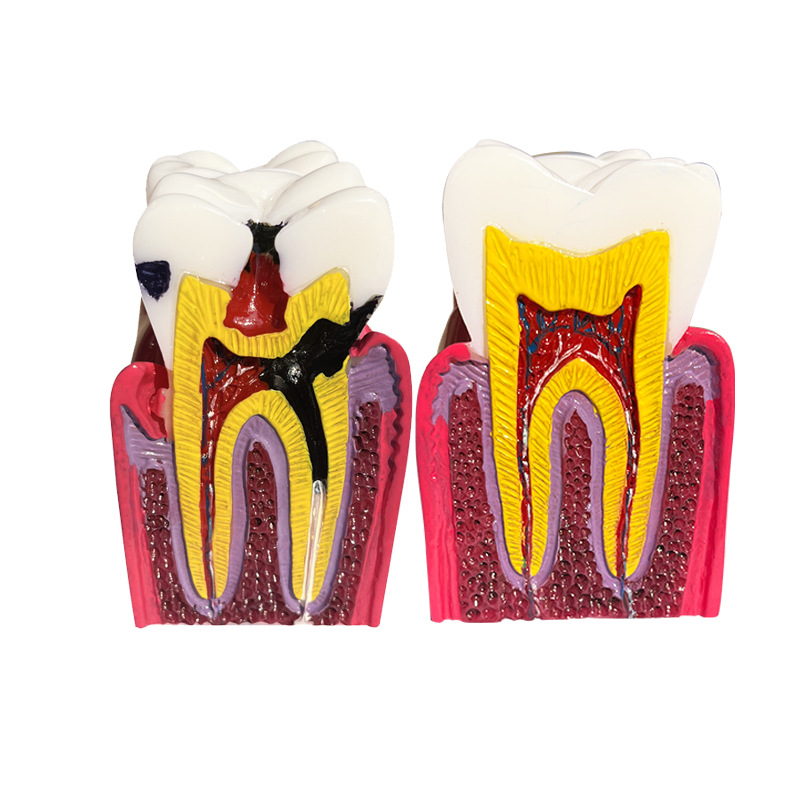 Equipo de enseñanza dental, modelo de comparación de caries 6x, modelo oral, modelo de enseñanza, modelo de dientes