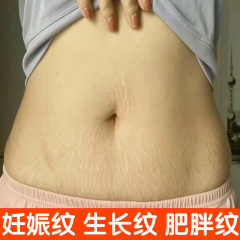ビューティーサロン妊娠線修復エッセンシャルオイル産後妊娠線除去肥満線成長線予防鎮静引き締め修復クリーム