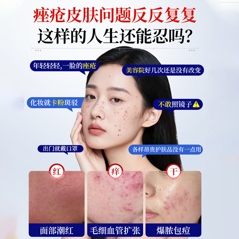 岩井昃弘酒糟鼻草莓鼻去红鼻子黑头收缩毛孔专用修护鼻头红血丝膏|undefined