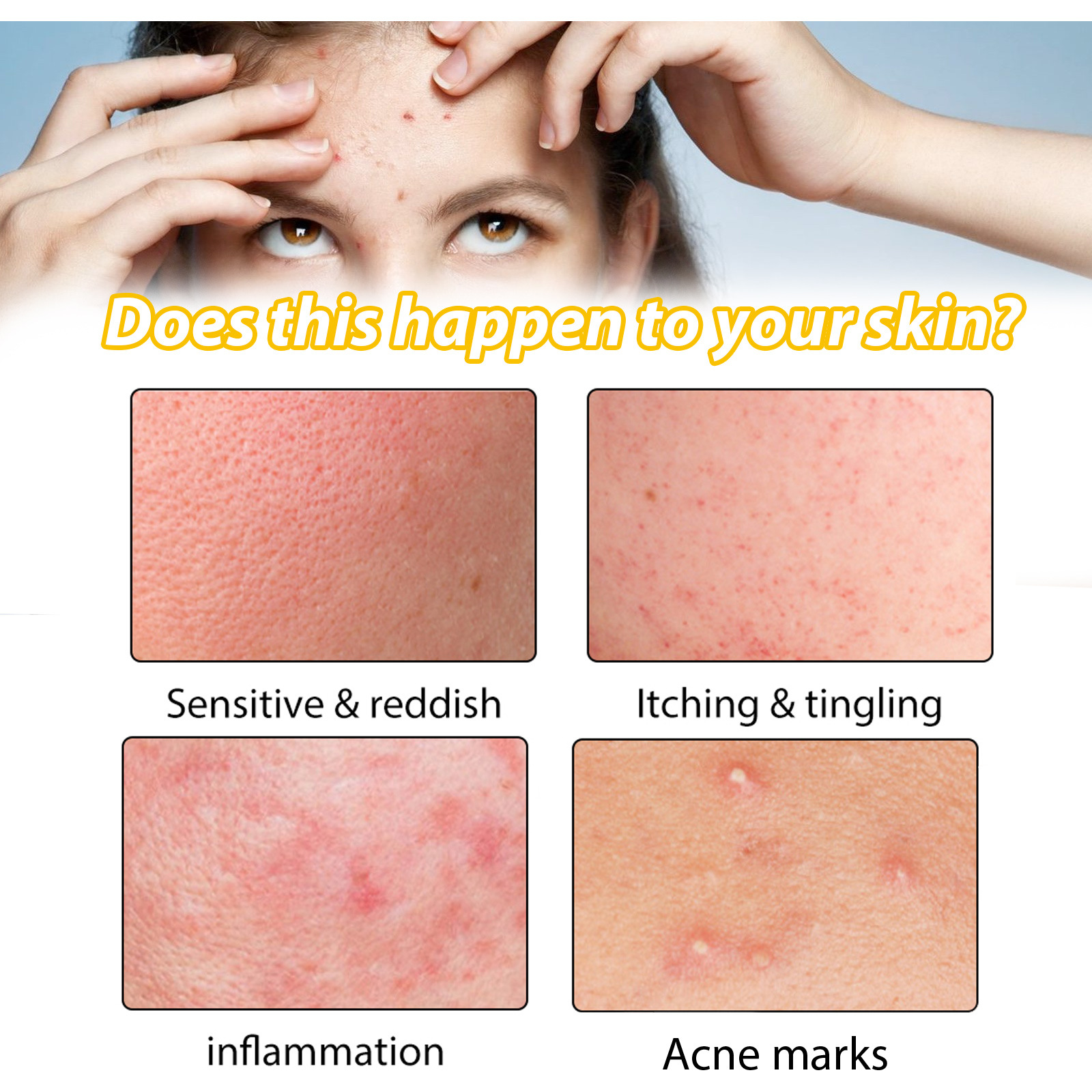 EELHOE Hautpflege reduziert Pickel, beseitigt Akne im Mund und verkleinert die Poren_voghion.com