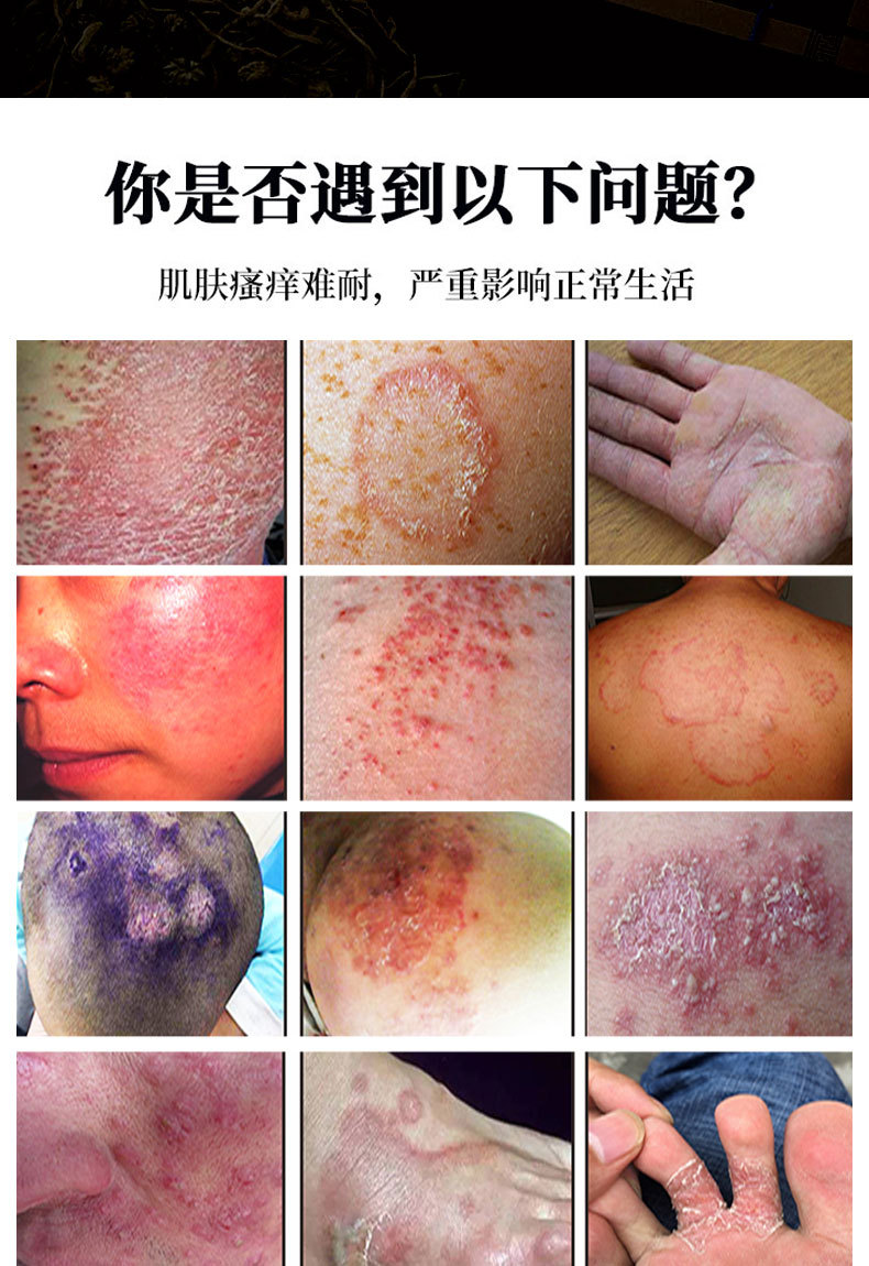 Qi Du Pi Xuan Kang Antibacterial Spray and Cream for Foot Odor and Itching External Use 60ml Plus 20g specifications