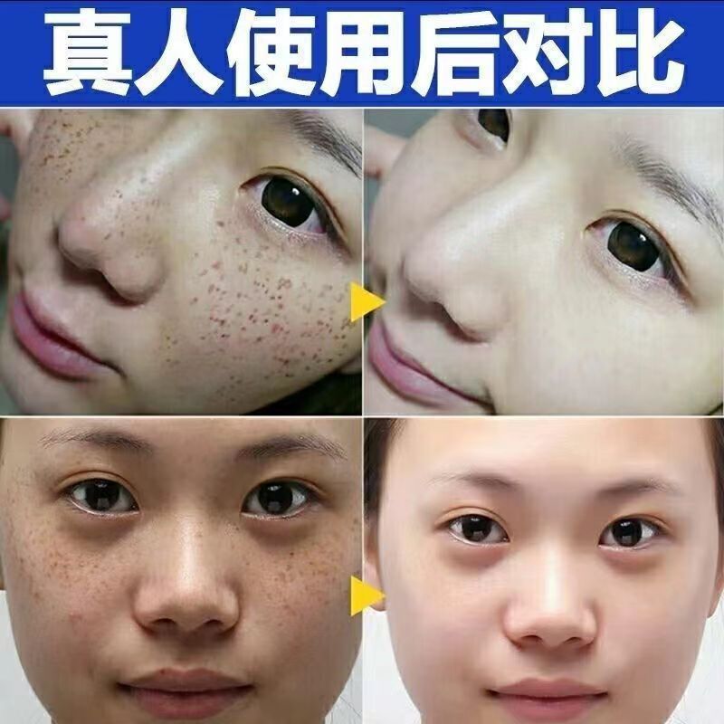 ハーブクレンジングマスク、5日間で黒ずみを吸収するマスク、黒ずみやニキビを取り除き、肌を若返らせ明るくする、エステサロン用ピールオフマスク|undefined