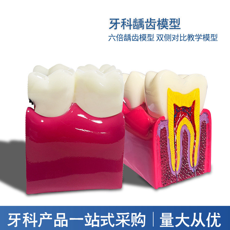 Equipo de enseñanza dental, modelo de comparación de caries 6x, modelo oral, modelo de enseñanza, modelo de dientes