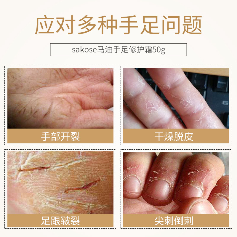sakose horse oil antifreeze moisturizing cream hand balm for dry itchy feet and anti-crack balm moisturizing and nourishing autumn and winter feet