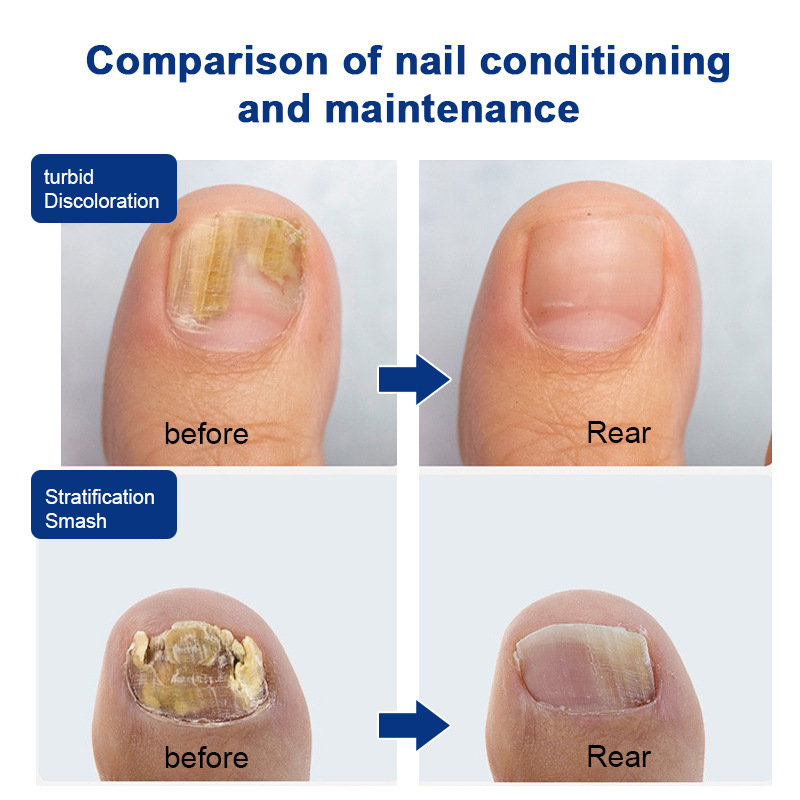 跨境灰指甲修护液 PUVIDA FungalNailRepairLiquid灰甲液FDA认证|undefined