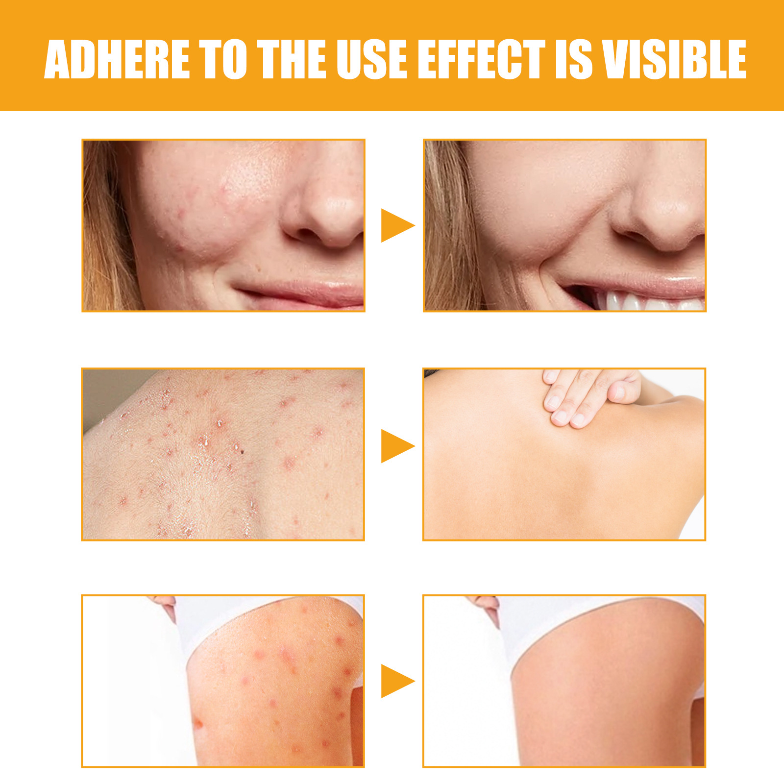 Jayusing Anti Cream Lighten and Acne Marks Esencja do nawilżania i naprawy skóry na ustach_voghion.com