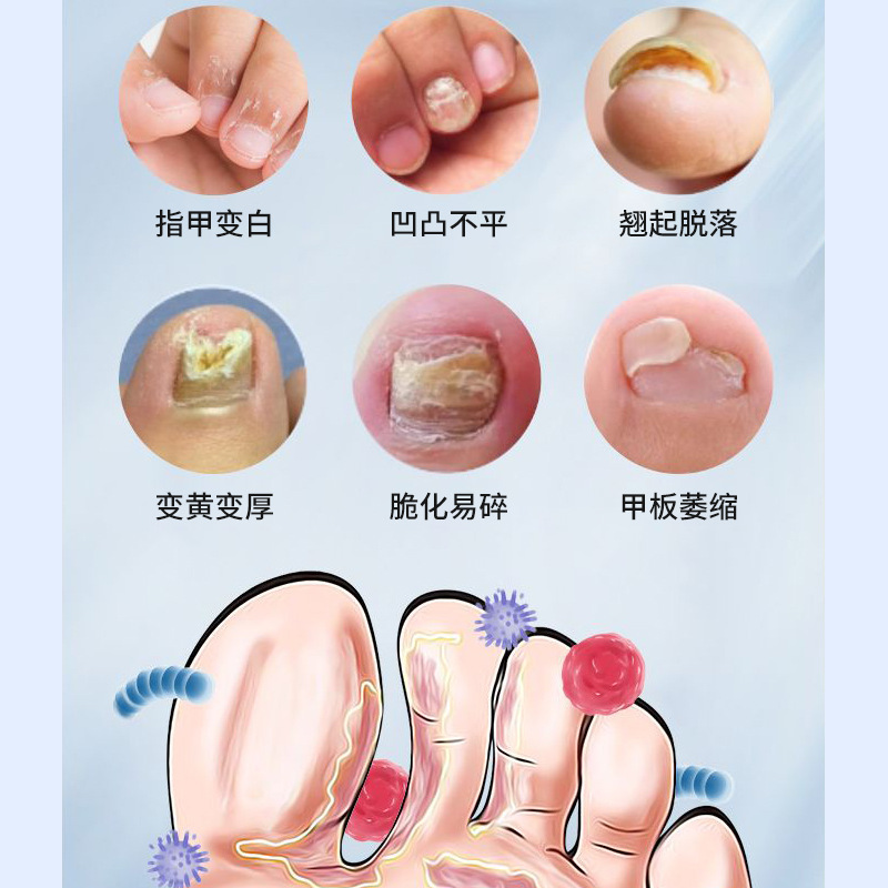 北京协和灰甲康外用保健液灰指甲裂甲嵌甲息肉引起不适护理液批发|undefined