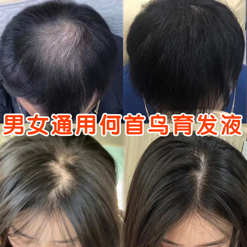何首乌育发液生头发液头发猛长修复毛囊保湿发际线防脱固发剂精华|undefined