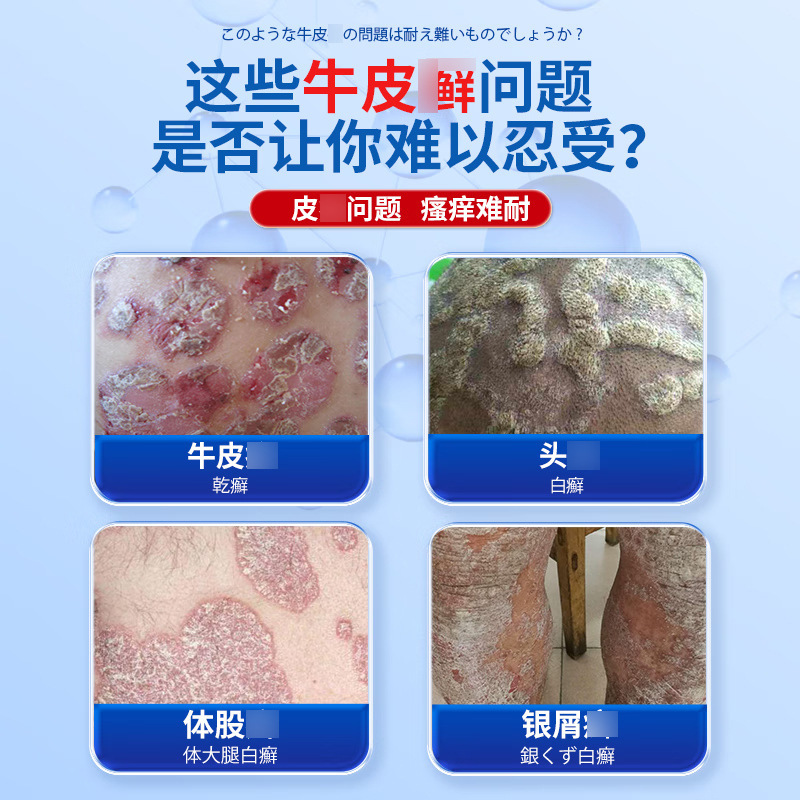Yaoshen Jingpin 乾癬かゆみ止め軟膏は、頑固な外用皮膚のかゆみ、赤み、中頭皮株を殺菌します。|undefined