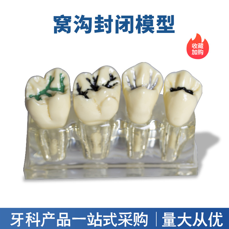 Modelo de cierre de fosas y fisuras dentales para niños contra la caries y la caries Modelo de cierre de fosas y fisuras Modelo transparente