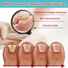 South Moon 指甲護理夜間貼片 修護灰指甲軟甲增厚指甲損傷指甲貼