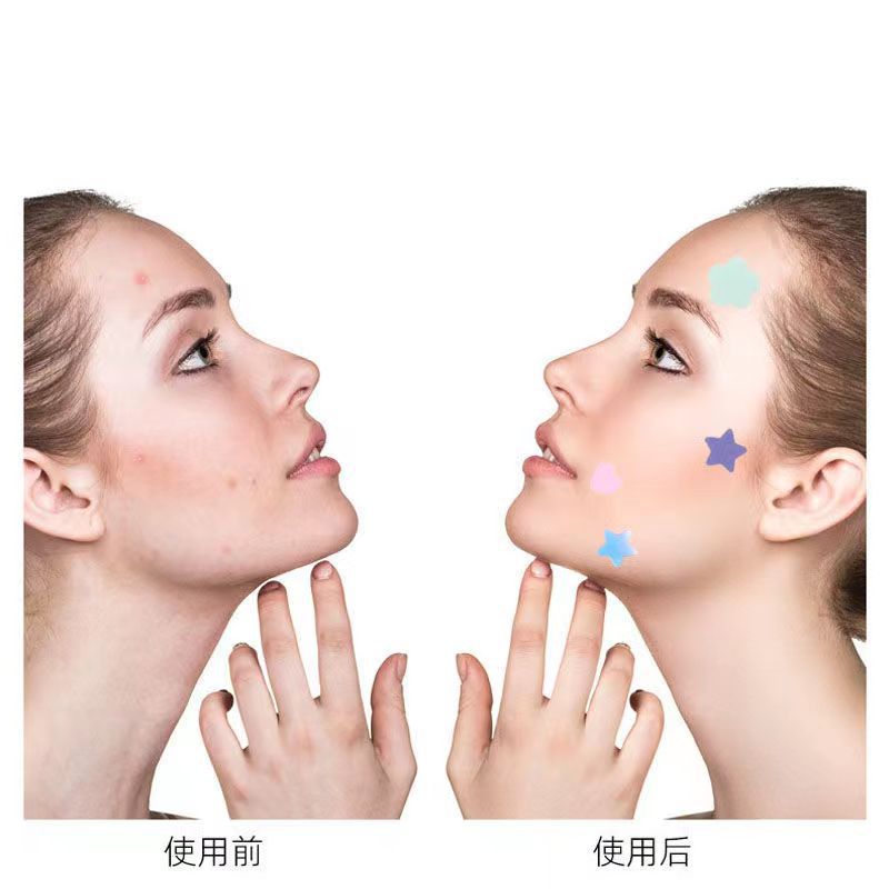 El acné parche hecho a mano estéril tridimensional acné eliminación de dibujos animados de color estrella acné marca parche cicatriz que cubre estudiante artificial 36 tabletas transfronterizas