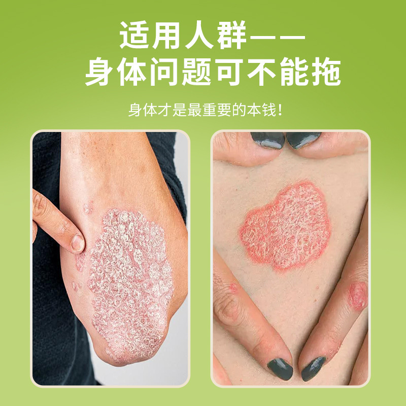 云南真菌王手足脱皮膏手足㿍外用保健乳膏足部瘙痒膏厂家直销代发|undefined