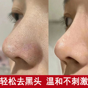 Blackhead Export Liquid to Remove Blackheads, Hospital Size, Small Bubble Acne, Purify Hair Follicles, Soften Cuticles, Shrink Pores, Blackhead Water
