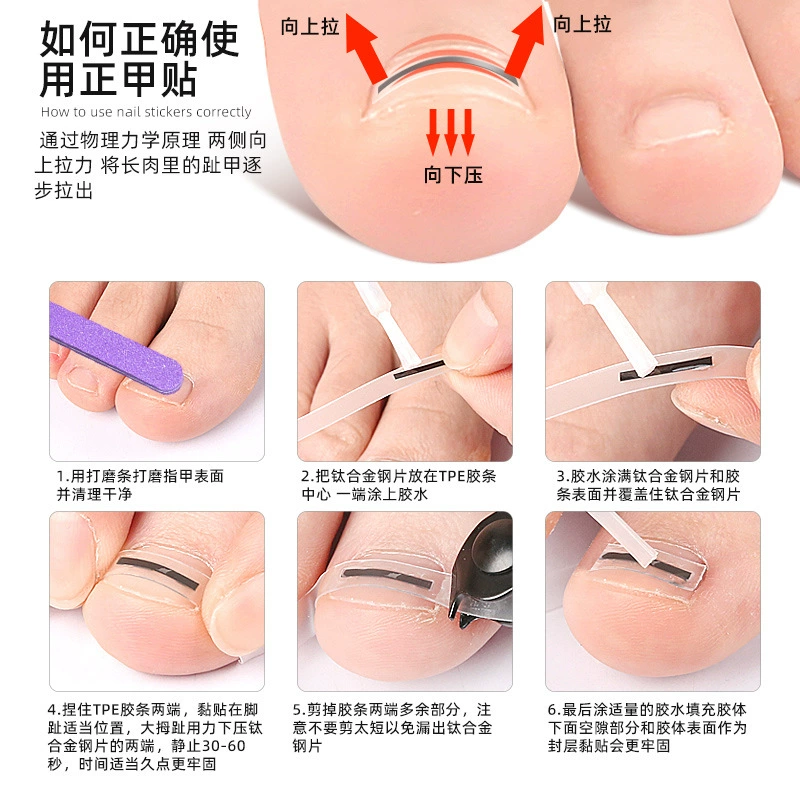 Armor patch Armor groove Armor coil Armor pull Armor patch toenails long flesh Armor pull Armor orthopedic device