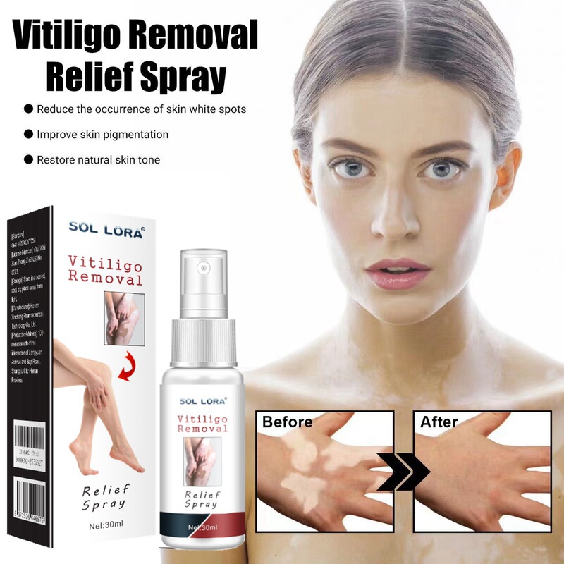 Sol Lora Cross-Border Amazon Aliexpress Wish White Spot Cream for External Use on Skin with White Spots, Sweat Spots, and Flecked Skin