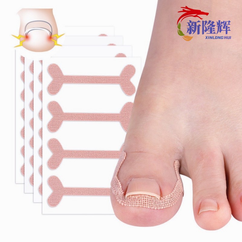 跨境专供免胶水正甲贴嵌甲矫正贴片甲沟修护贴脚趾甲长肉里专用