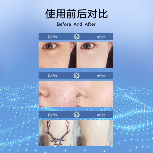 Small white spot nevus pen to remove spots, spot and mole removal artifact, laser beauty instrument, hemorrhoid spot nevus pen, special for beauty salons