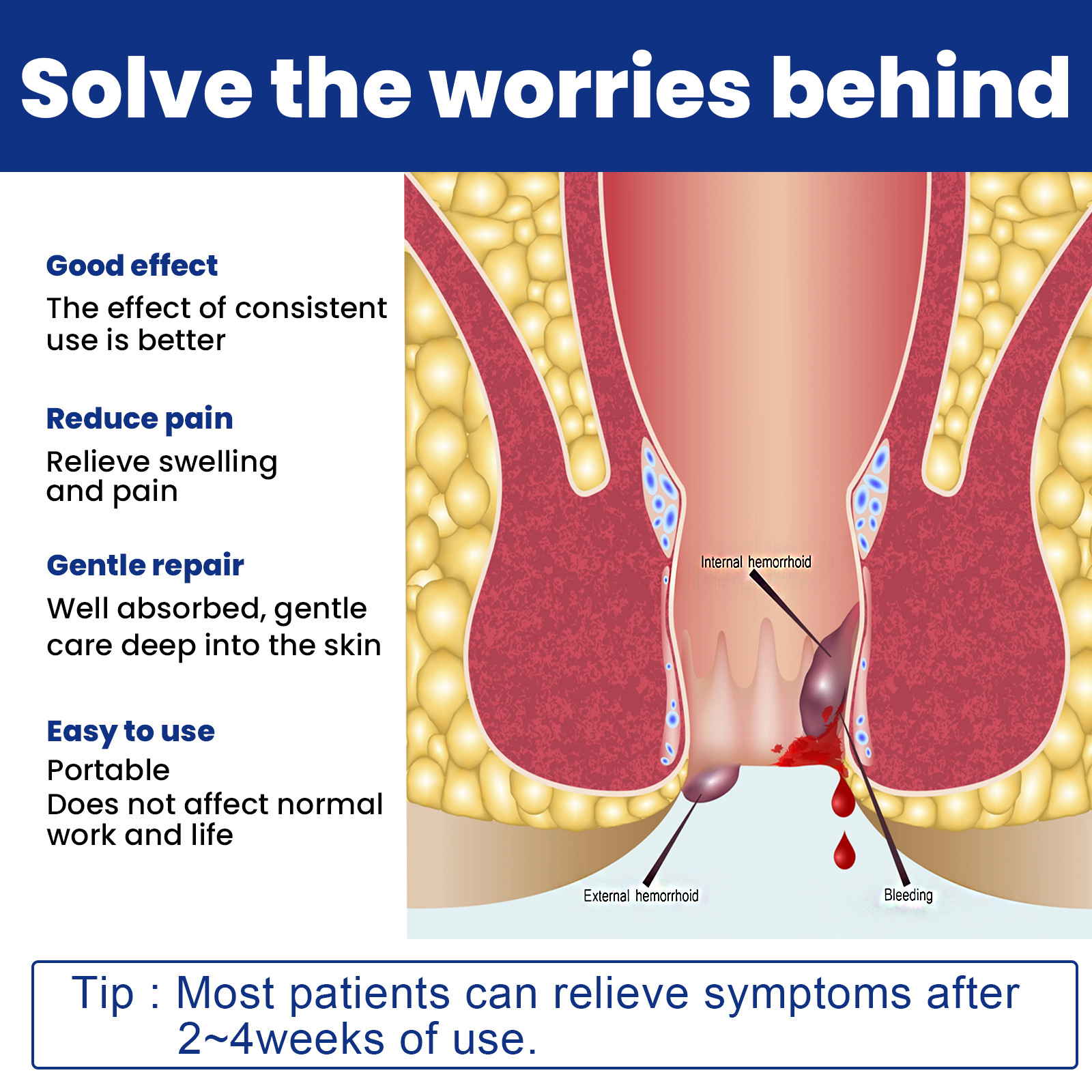 Lindert sanft gemischte Geschwüre innen und außen, gebrochene Fleischbällchen, Thrombosen, Hämorrhoiden, Hämorrhoidencreme_voghion.com
