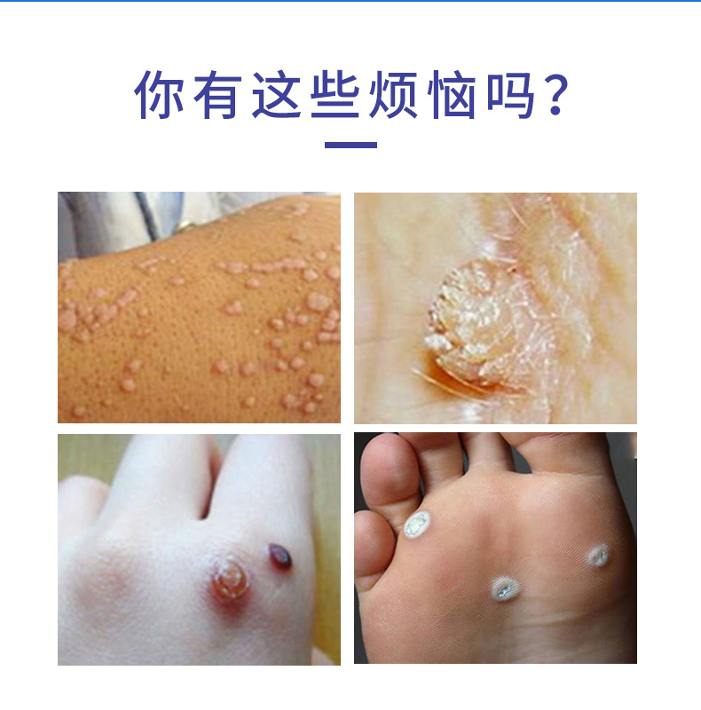 Dermfree克疣液尖锐疣丝状疣鸡眼液祛疣液肉球肉刺去瘊子跨境专供-阿里巴巴