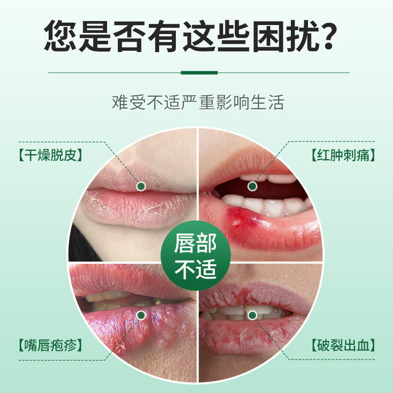 川弘宫廷唇炎专用药膏日本嘴唇炎干裂脱皮儿童三草油润唇膏口周炎|undefined
