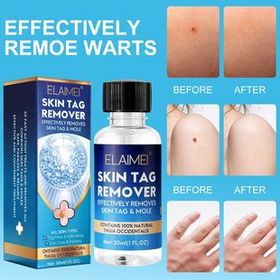 Cross-Border Elaimei Bottled Wart Removal Solution Skin Tag Gentle Wart Removal Solution 30ml