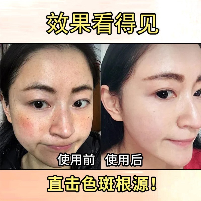 ハーブ美白そばかすクリームセット、シミ除去強化版そばかすクリーム、強力な黒いそばかす除去クリーム|undefined