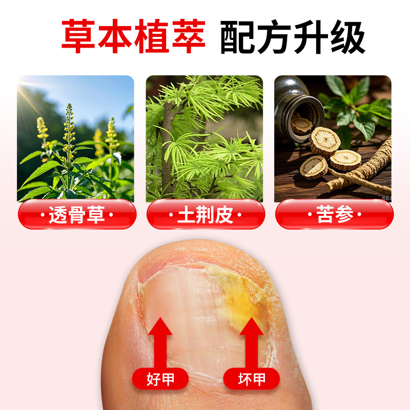 爪真菌症ソリューションフットケアソリューション爪真菌症健康ソリューション肥厚明るい爪真菌症ネットソフト爪クリーム爪真菌症ソリューション卸売|undefined
