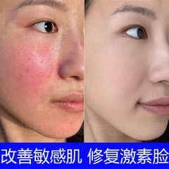 積雪草修復クリームは敏感肌の修復を改善します。