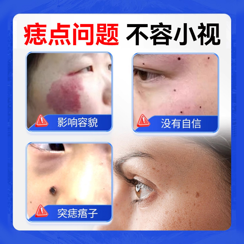 北京同仁堂点痣套盒点痣膏无痕非药水外用保健膏祛志膏点斑去痣液|undefined
