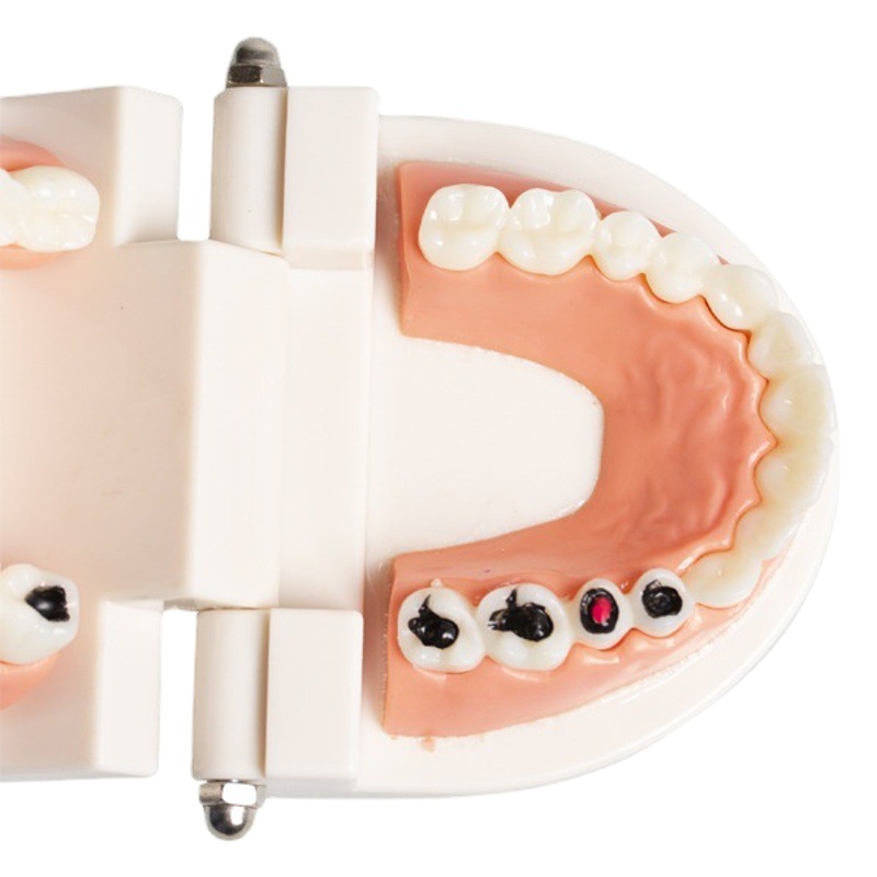 Modelo de caries dental para niños, modelo de cuidado de la enseñanza del cepillado de dientes de jardín de infantes, modelo de patología dental de la enseñanza oral