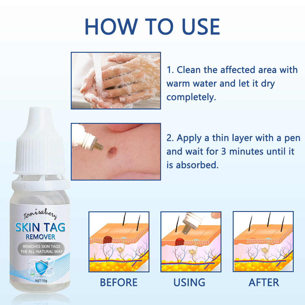 Skin Tag-Reinigungsflüssigkeit zur Wachstumskontrolle, Hühneraugenklappe und Entfernung von Dornwarzen_voghion.com