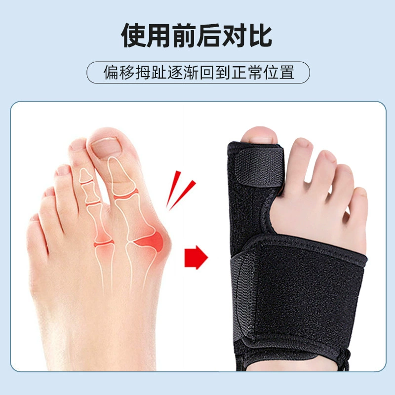 Big Thumb Valvular Orthosis Big Foot Bone Toe Overlapping Toe Splitter Adjustable Day and Night Toe Fixing Strap