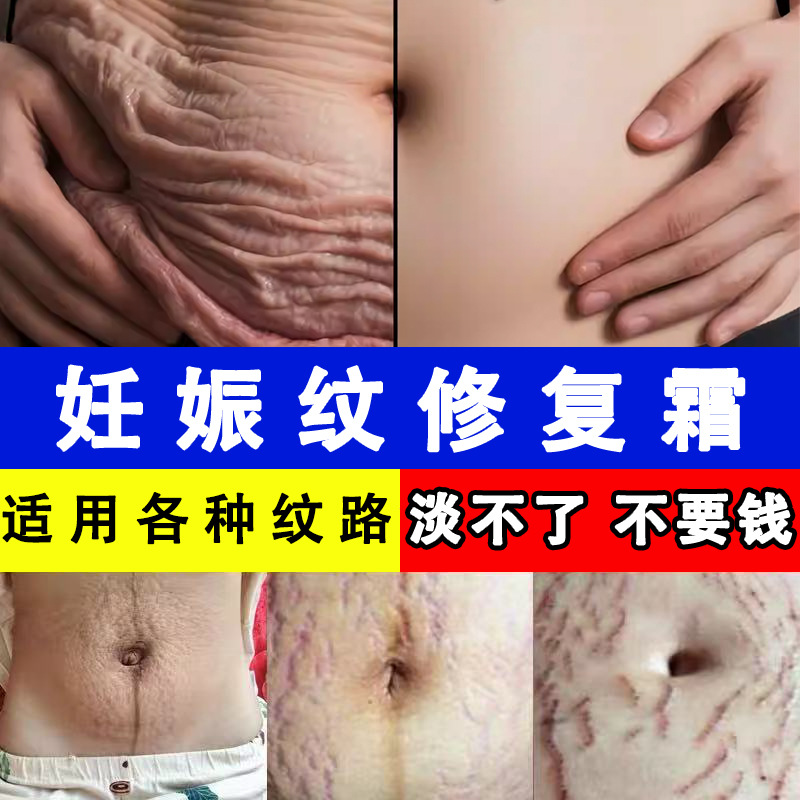 Stretch Mark Lightening Cream to Remove Pregnancy Marks, Postpartum Repair Cream, No Mesh Removal of Obesity Marks, Hospital Line Stretch Mark Repair Cream
