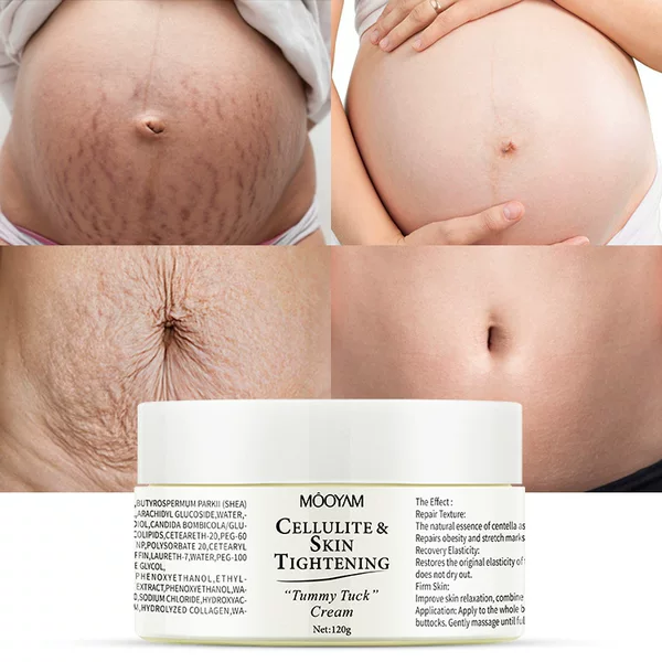 Stretch Mark Cream, Obesity Body Mark Care Cream, Firming, Nourishing and Lightening Postpartum Stretch Mark Repair Cream