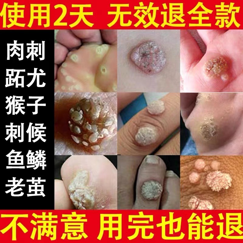 疣除去、猿の肉粒、魚の鱗、ほくろ、いぼ、足疣、魚の目軟膏、フットケア、フットバス、フットマッサージ|undefined