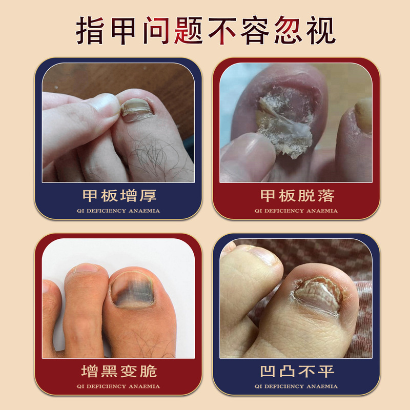 香港大薬局灰爪鳳仙花外用保健液は甲膏灰甲黒甲厚甲外用保健液に行きます。|undefined