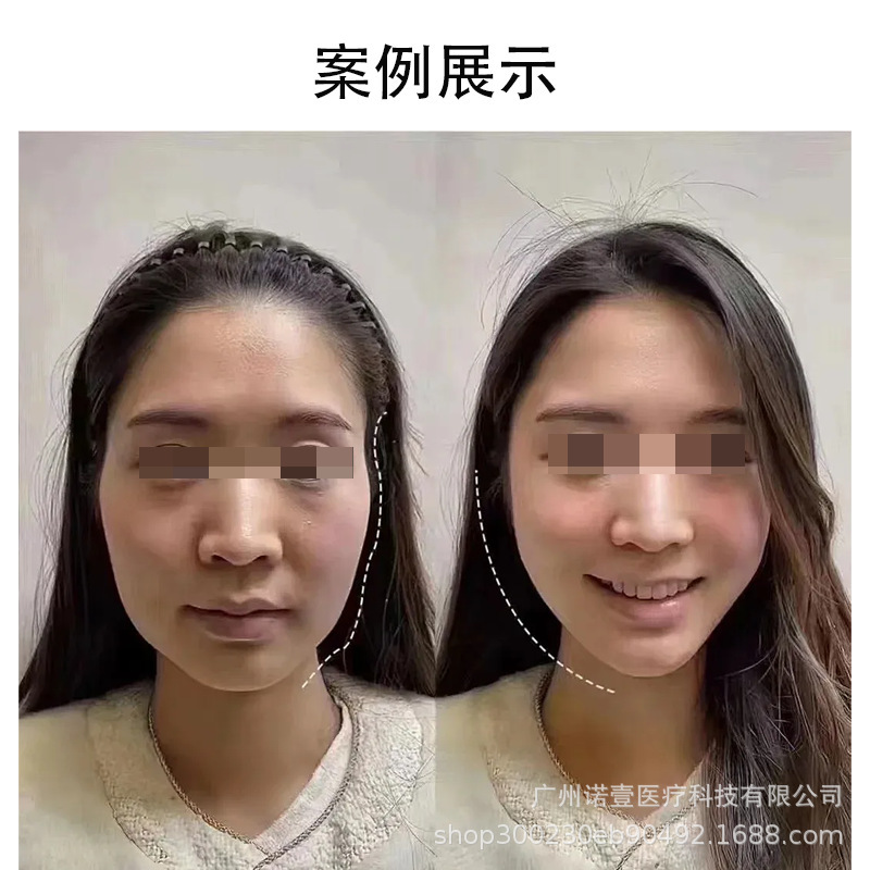 大牌同款童颜針PDLLA聚双旋乳酸刺激胶原蛋白紧致提拉轮廓固定|undefined