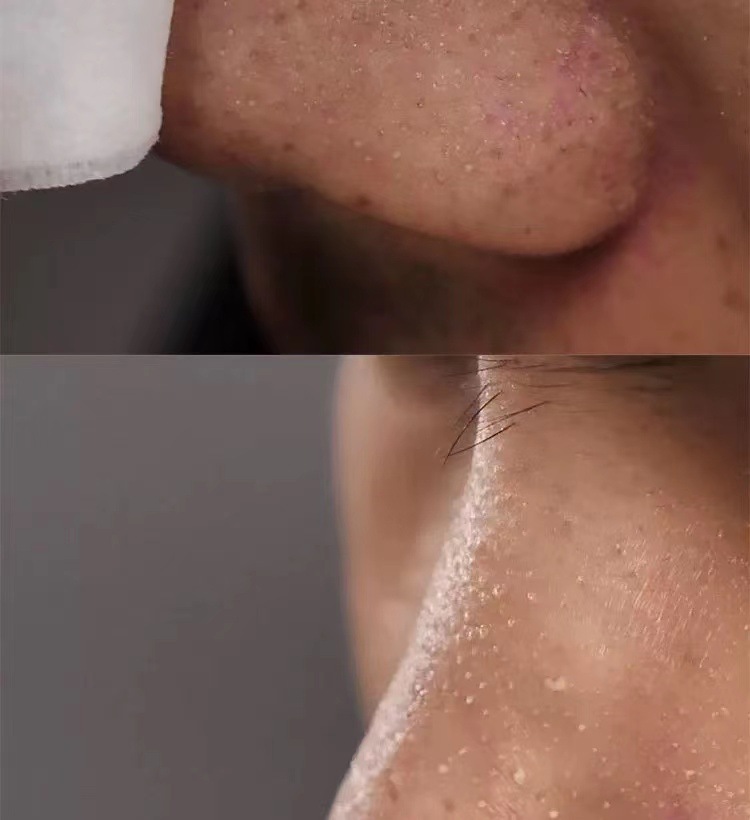 Blackhead Export Liquid Image 6