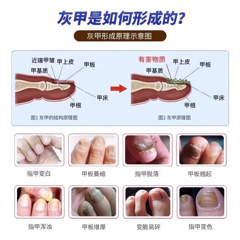 灰指甲打磨机器电动磨甲器硬脚趾甲修甲专用工具锉刀老人灰厚指甲|undefined