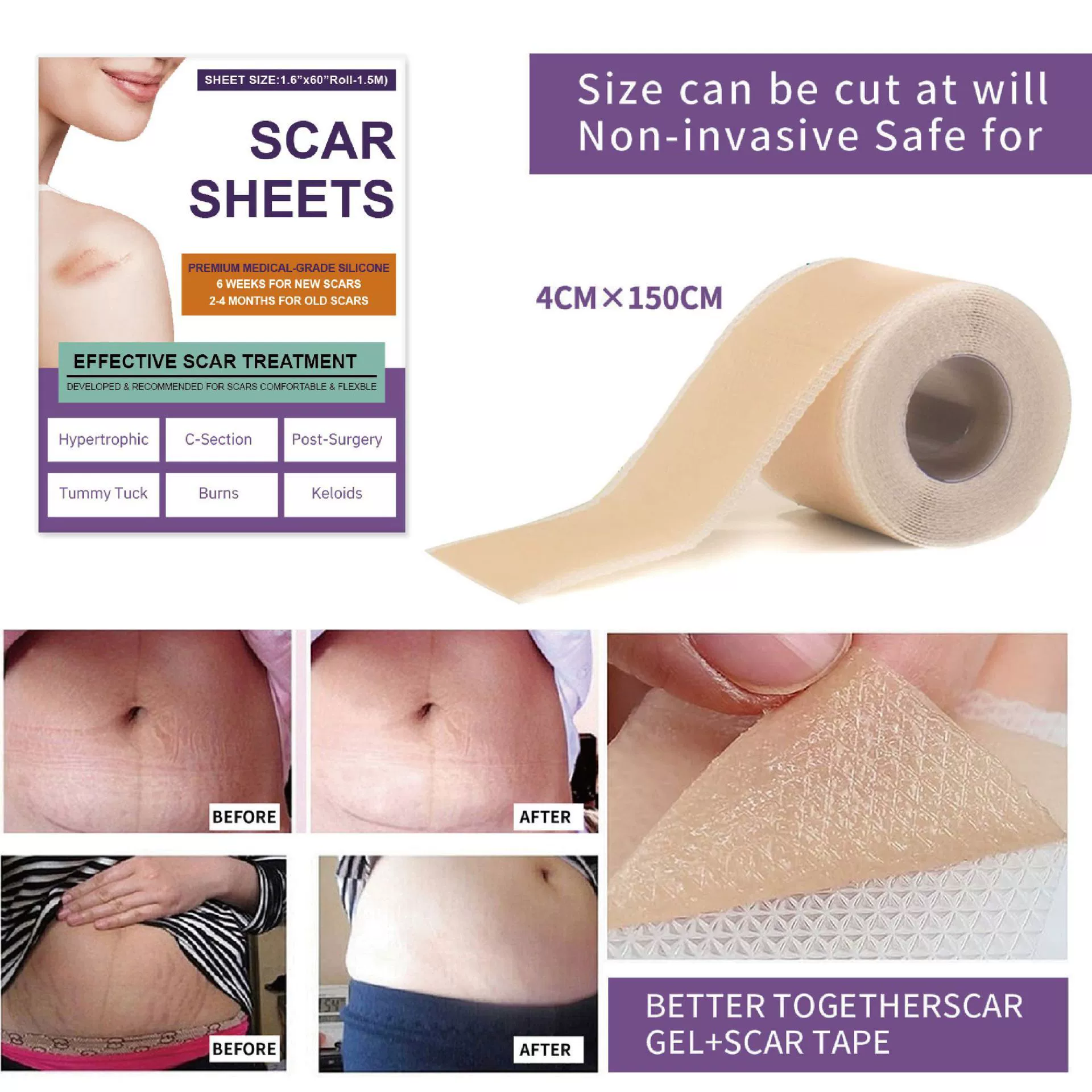 Трансграничные BUPY силиконовые шрамы для удаления шрамов для ухода за телом Силиконовый гель шрамы для шрамов