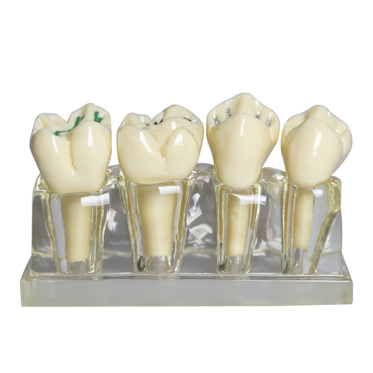 Modelo dental molde modelo dental modelo de enseñanza dental removible dentadura oral cepillado Preparación del diente modelo resina