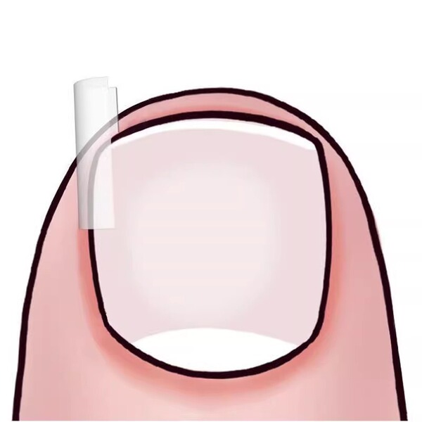Orthotics for contouring for nails