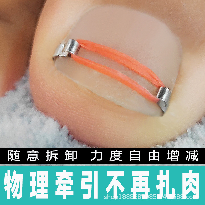 Nail nail buckle nail groove nail inlay straightener nail sticking nail roll nail into the meat long foot nail pricking meat correction special