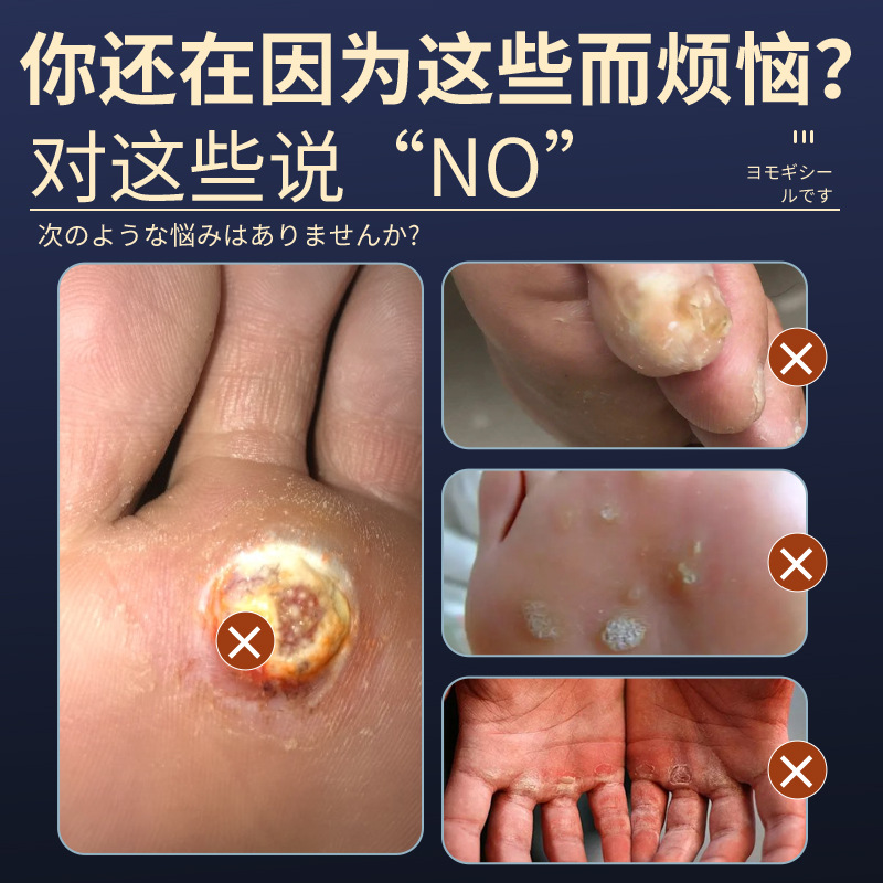 明野製藥雞眼貼老繭腳繭護理貼雞疣貼肉刺瘊刺雞眼膏貼雞尤康貼